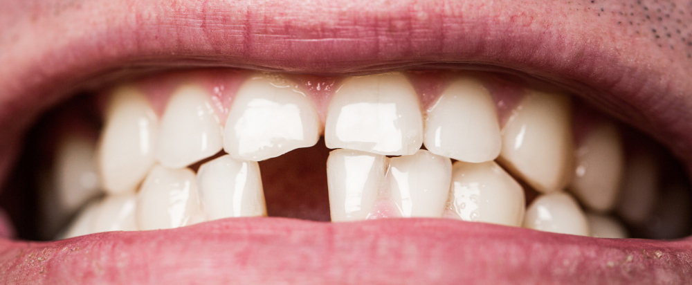 A broken or cracked tooth