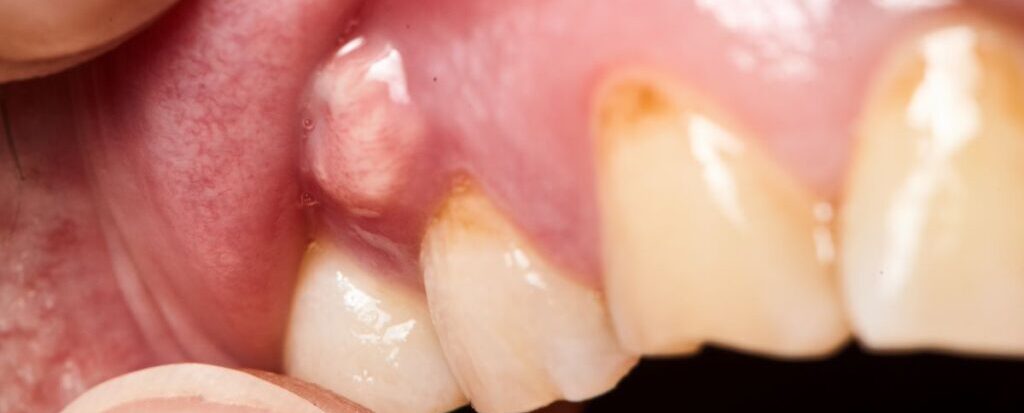 A dental abscess